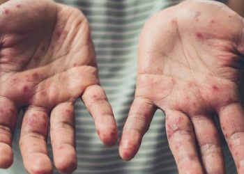 DSÖ: Kovid-19, kızamıkla mücadeleyi sekteye uğratabilir