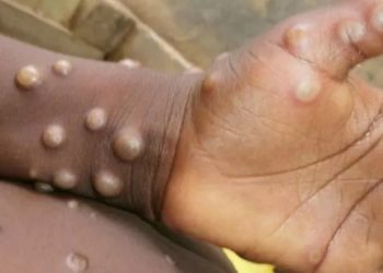 İngiltere’nin ardından Portekiz ve İspanya’da da görüldü: Maymun çiçeği virüsü yayılıyor