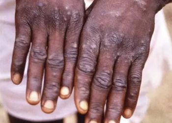 Hollanda’da maymun çiçeği vaka sayısı bini aştı