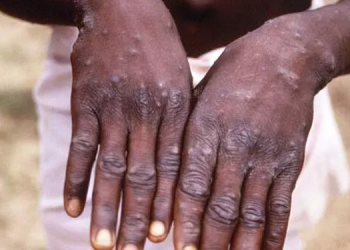 Maymun çiçeği, 12 kat daha hızlı mutasyona uğruyor