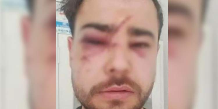 Sokak sanatçısının yüzünde şişe kırdılar Sokak sanatçısının yüzünde şişe kırdılar